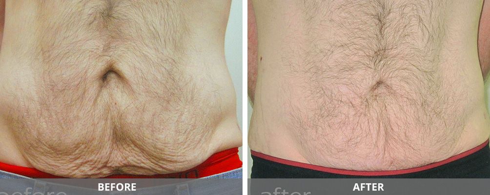 Body Sculpting Before & After