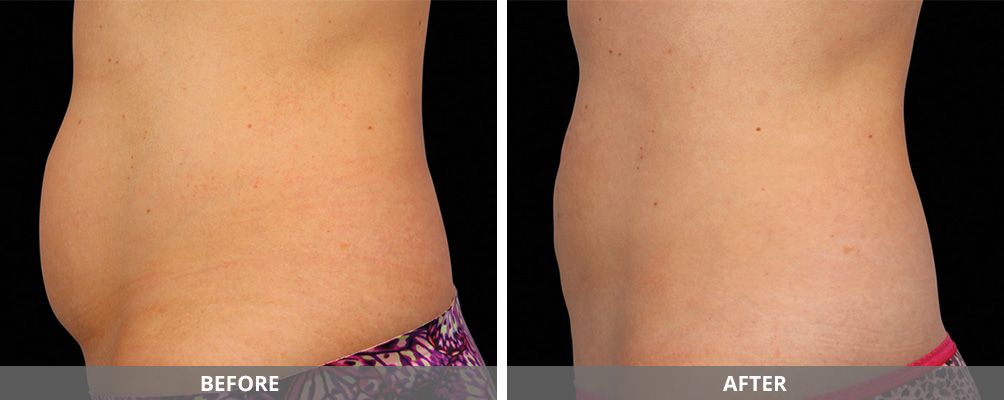 Body Sculpting Before & After