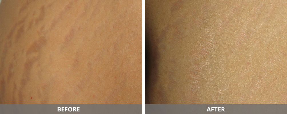 Body Sculpting Before & After