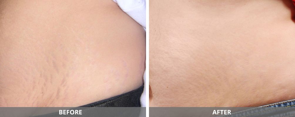 Body Sculpting Before & After