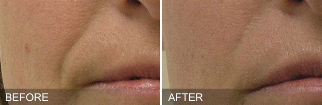 Hydrafacial Before & After