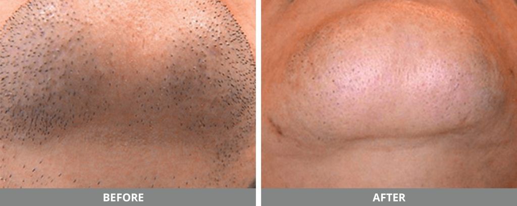 Laser Hair Removal Before & After