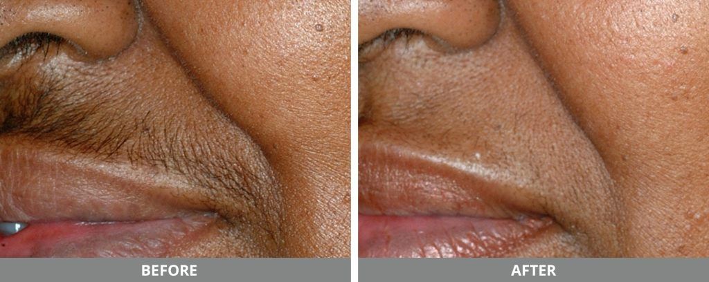 Laser Hair Removal Before & After