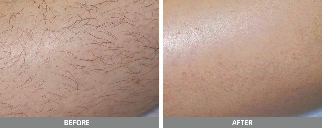 Laser Hair Removal Before & After
