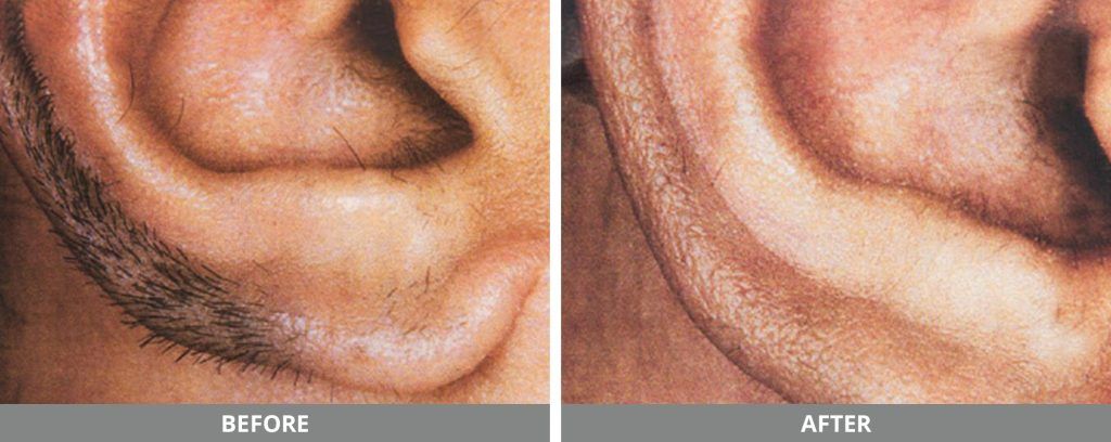 Laser Hair Removal Before & After