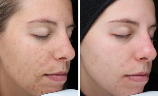 Vi Peels Before & After