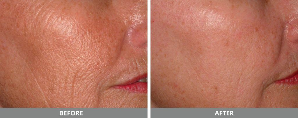 Ipl Photofacial Before & After