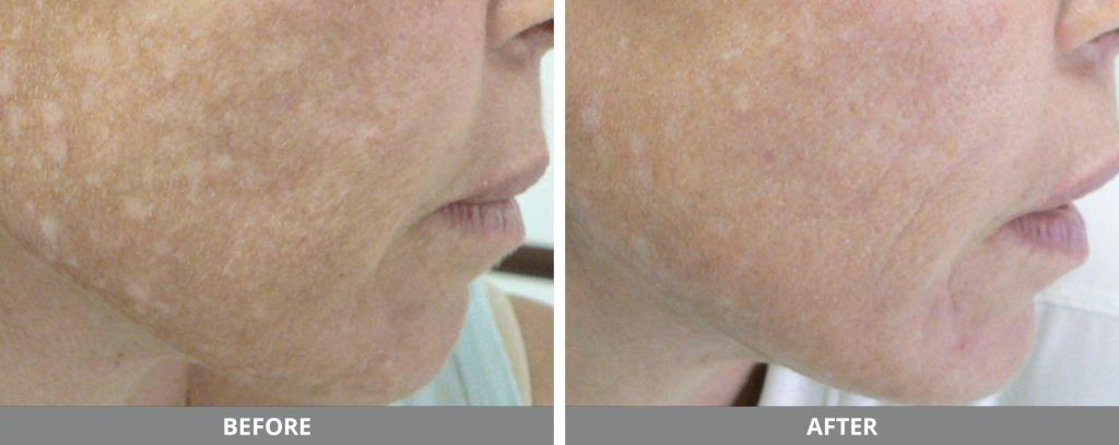 Ipl Photofacial Before & After