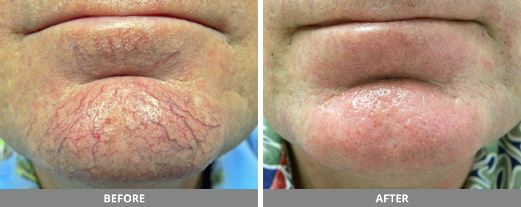 Ipl Photofacial Before & After