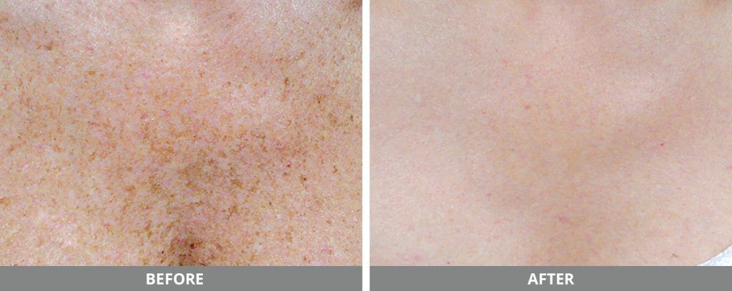 Ipl Photofacial Before & After