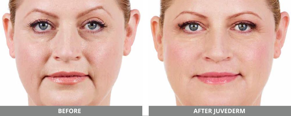 Juvederm Before & After