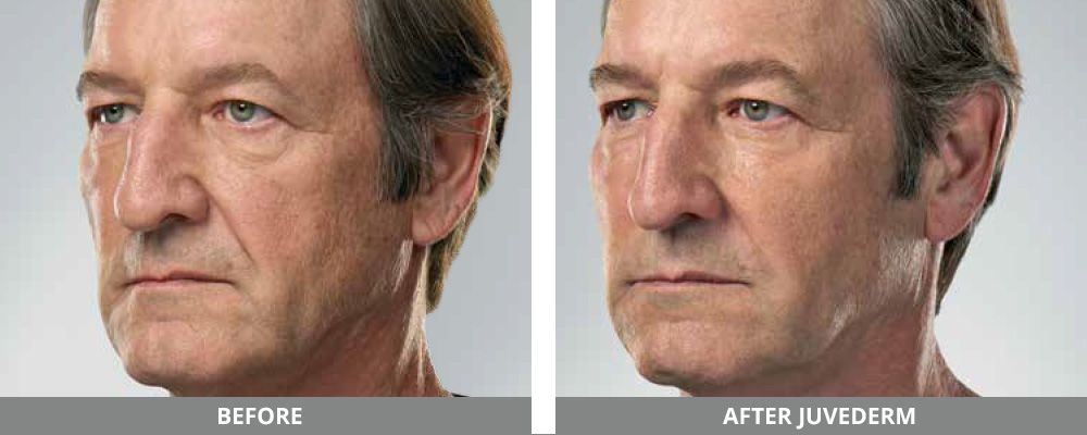 Juvederm Before & After