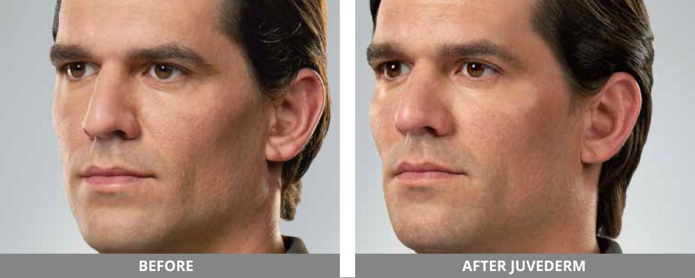 Juvederm Before & After