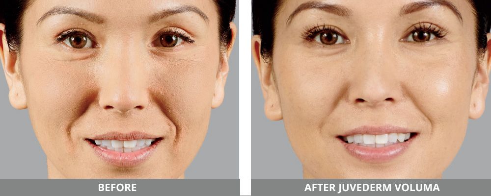 Juvederm Before & After