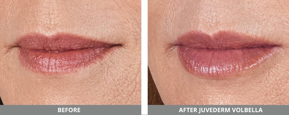 Juvederm Before & After