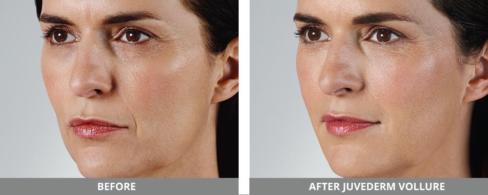 Juvederm Before & After