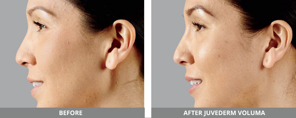Juvederm Before & After