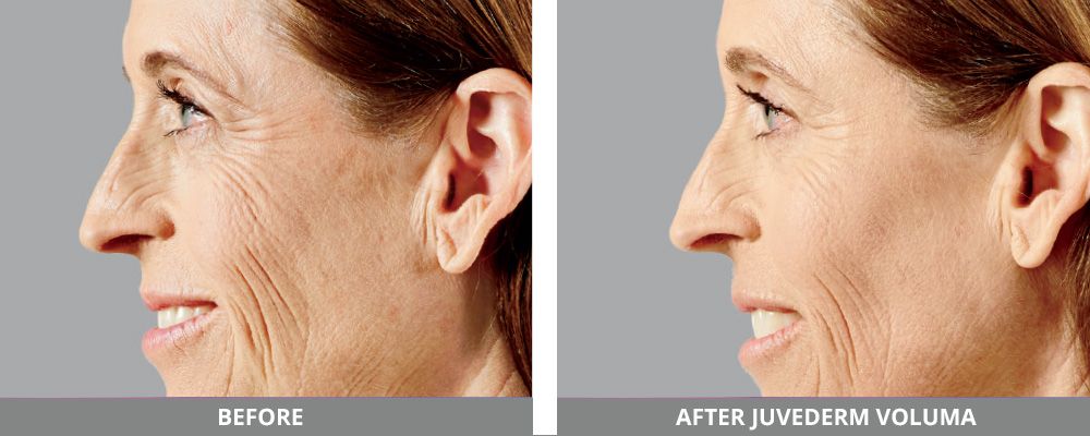 Juvederm Before & After