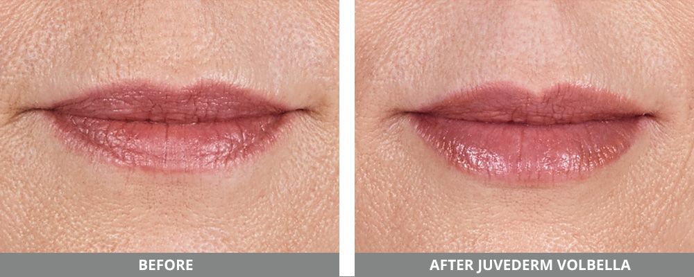 Juvederm Before & After