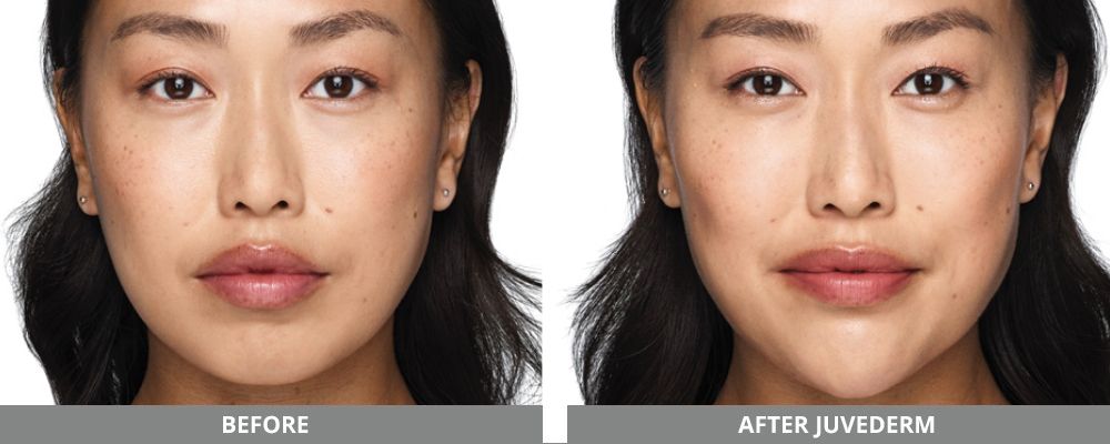 Juvederm Before & After