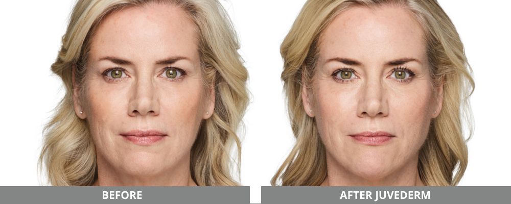 Juvederm Before & After
