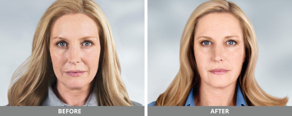 Sculptra Before & After