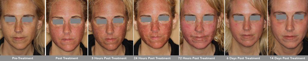 Co2 Laser Before & After