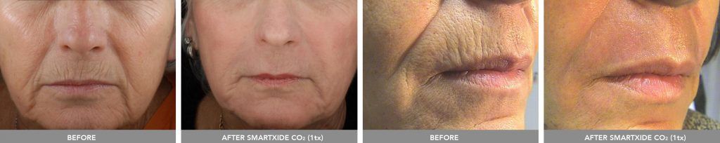 Co2 Laser Before & After