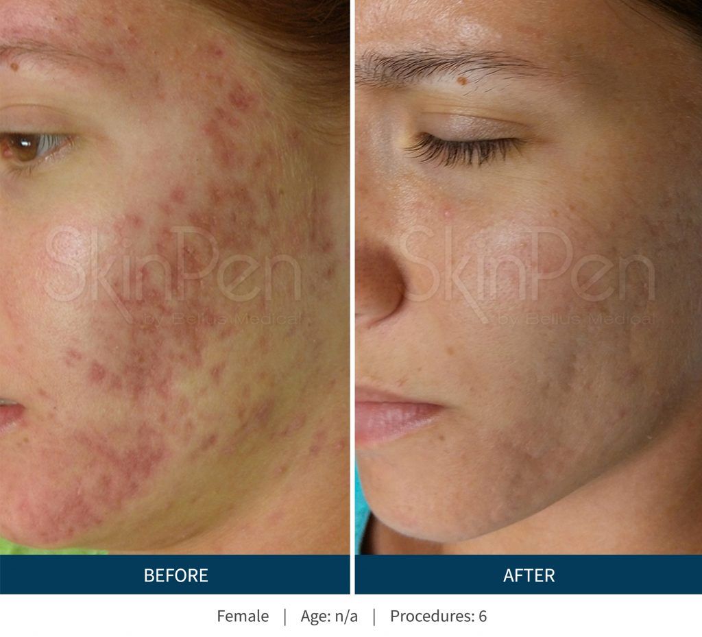 Microneedling Before & After