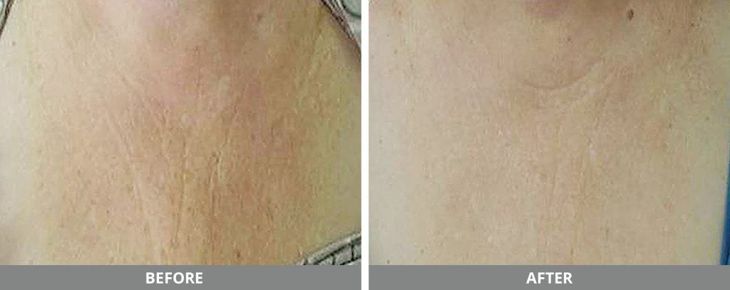 Viora Reaction Before & After