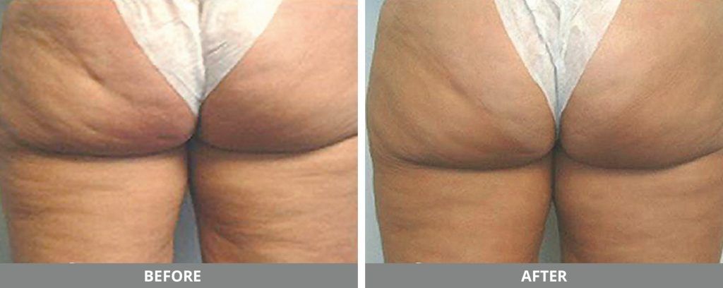 Viora Reaction Before & After