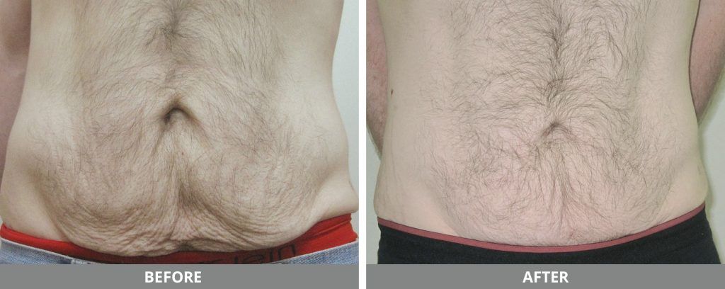 Viora Reaction Before & After