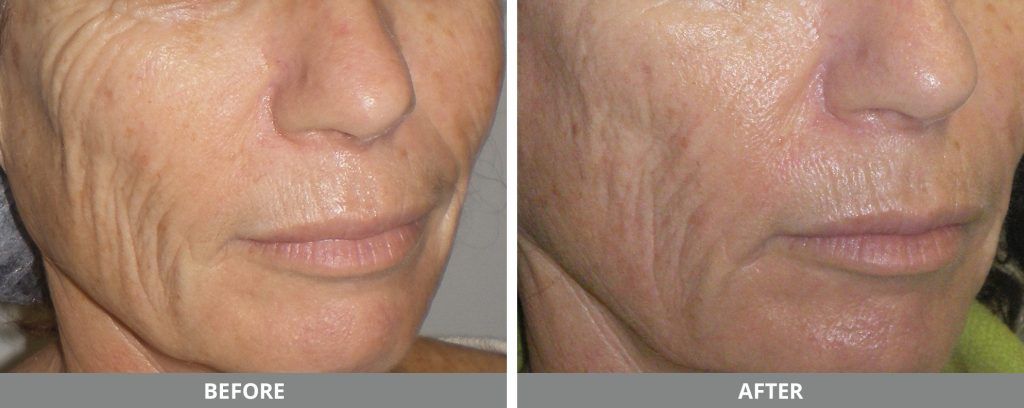 Viora Reaction Before & After