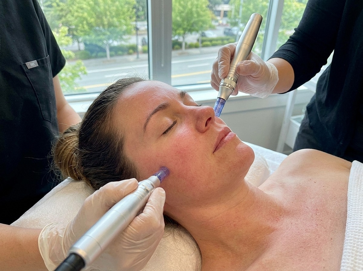 Microneedling In Bellevue, WA – Reveal Smoother Skin Today