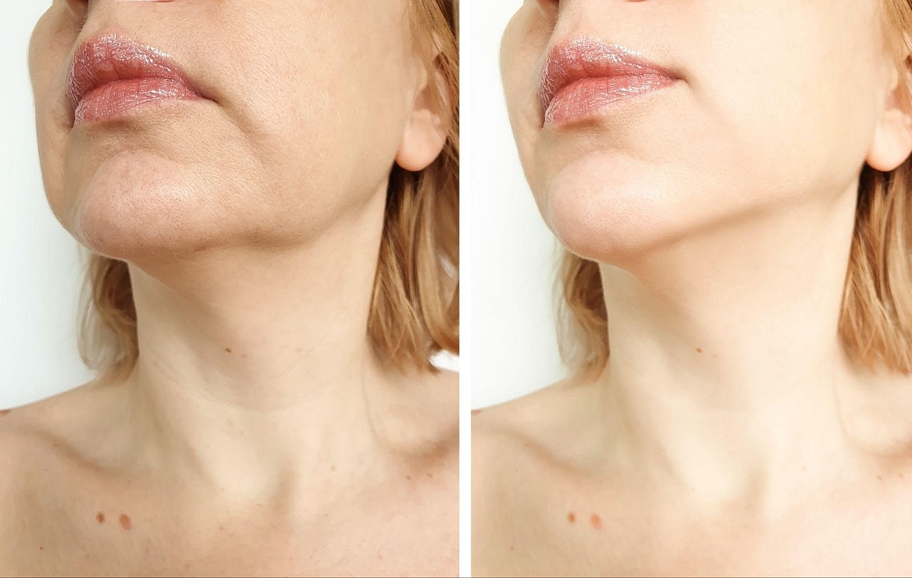 What We Can Treat With Skin Tightening